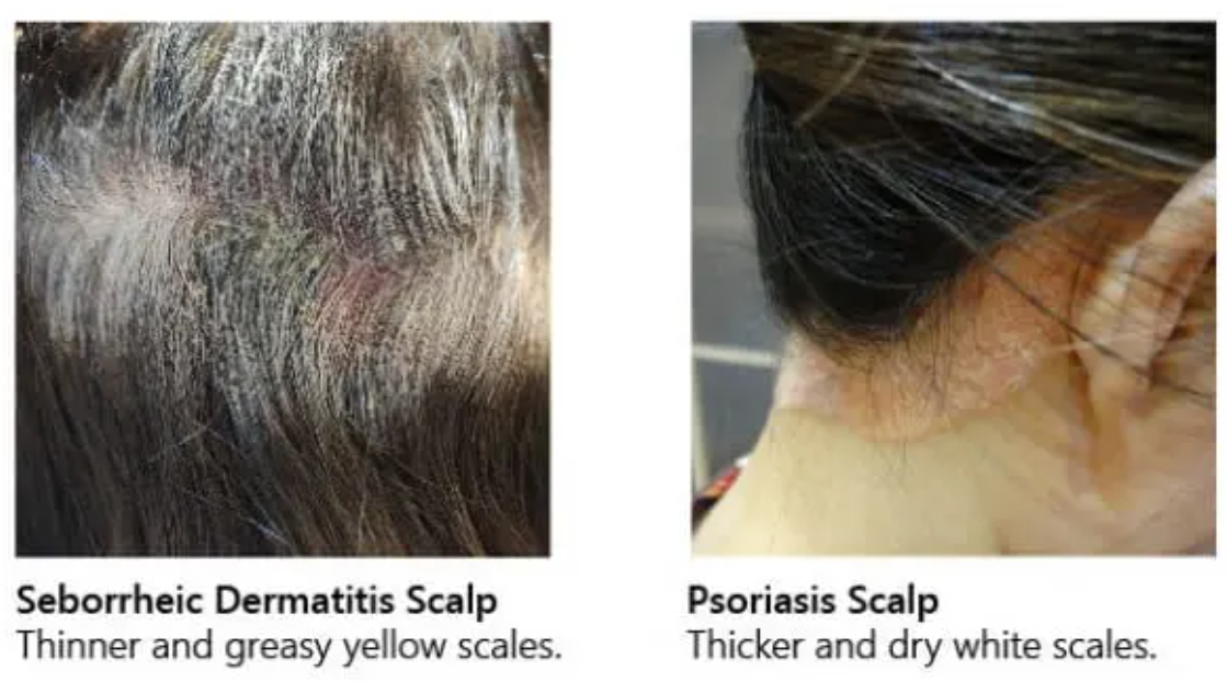 What’s the Difference Between Psoriasis and Seborrheic Dermatitis Scalp?